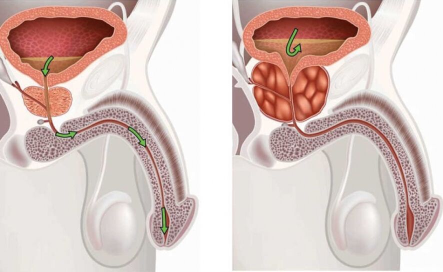 Informationen zur Krankheit Prostatitis